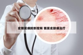 皮银屑病挑刺视频 银屑皮肤病治疗