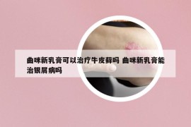 曲咪新乳膏可以治疗牛皮藓吗 曲咪新乳膏能治银屑病吗