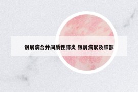 银屑病合并间质性肺炎 银屑病累及肺部