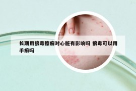 长期用狼毒擦癣对心脏有影响吗 狼毒可以用手癣吗