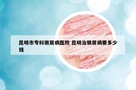昆明市专科银屑病医院 昆明治银屑病要多少钱