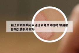腿上有银屑病可以通过公务员体检吗 银屑病影响公务员录取吗
