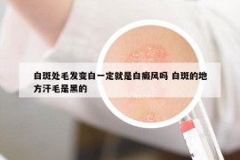 白斑处毛发变白一定就是白癜风吗 白斑的地方汗毛是黑的