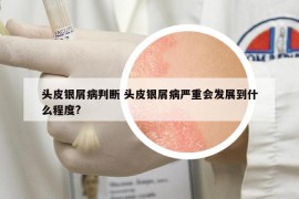 头皮银屑病判断 头皮银屑病严重会发展到什么程度?
