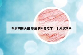 银屑病用头孢 银屑病头孢吃了一个月没效果