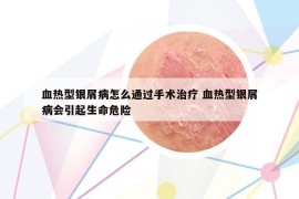 血热型银屑病怎么通过手术治疗 血热型银屑病会引起生命危险
