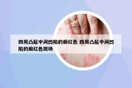四周凸起中间凹陷的癣红色 四周凸起中间凹陷的癣红色斑块