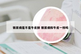 银屑病是不是牛皮鲜 银屑病和牛皮一样吗