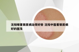 沈阳哪里银屑病治得好些 沈阳中医看银屑病好的医生