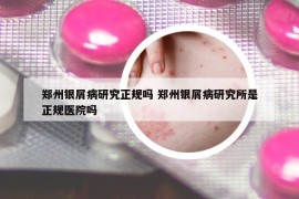 郑州银屑病研究正规吗 郑州银屑病研究所是正规医院吗