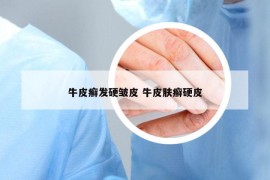 牛皮癣发硬皱皮 牛皮肤癣硬皮