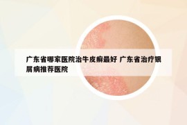 广东省哪家医院治牛皮癣最好 广东省治疗银屑病推荐医院