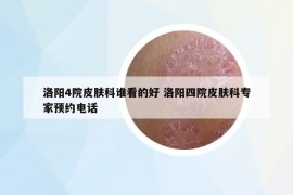 洛阳4院皮肤科谁看的好 洛阳四院皮肤科专家预约电话