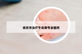 南京市治疗牛皮癣专业医院