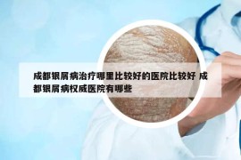 成都银屑病治疗哪里比较好的医院比较好 成都银屑病权威医院有哪些