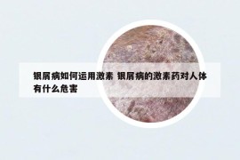 银屑病如何运用激素 银屑病的激素药对人体有什么危害