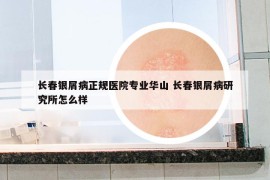 长春银屑病正规医院专业华山 长春银屑病研究所怎么样