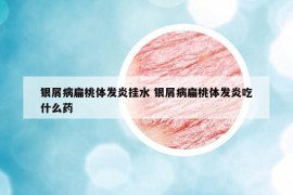 银屑病扁桃体发炎挂水 银屑病扁桃体发炎吃什么药