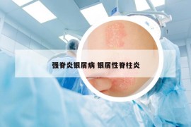强脊炎银屑病 银屑性脊柱炎