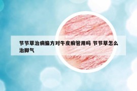 节节草治病偏方对牛皮癣管用吗 节节草怎么治脚气
