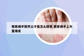 银屑病手裂开口子是怎么回事 银屑病手上大量爆皮