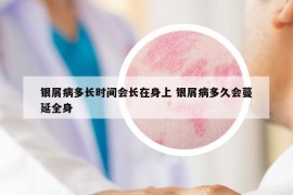 银屑病多长时间会长在身上 银屑病多久会蔓延全身
