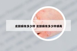 皮肤癣有多少种 皮肤癣有多少种病毒