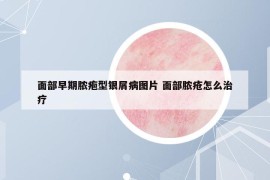 面部早期脓疱型银屑病图片 面部脓疮怎么治疗
