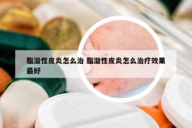 脂溢性皮炎怎么治 脂溢性皮炎怎么治疗效果最好