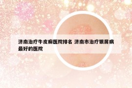 济南治疗牛皮癣医院排名 济南市治疗银屑病最好的医院