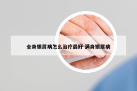 全身银屑病怎么治疗最好 满身银屑病