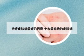 治疗皮肤病最好的药膏 十大最难治的皮肤病