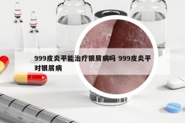 999皮炎平能治疗银屑病吗 999皮炎平对银屑病