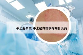 手上起白斑 手上起白斑很痒用什么药