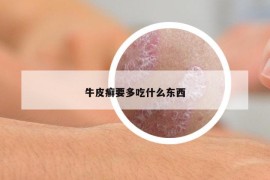 牛皮癣要多吃什么东西