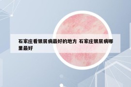 石家庄看银屑病最好的地方 石家庄银屑病哪里最好
