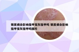 银屑病会影响指甲变灰指甲吗 银屑病会影响指甲变灰指甲吗图片