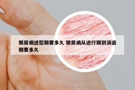 银屑病进型期要多久 银屑病从进行期到消退期要多久