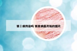 银痟病传染吗 银屑病最开始的图片