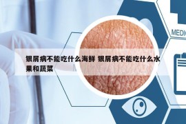 银屑病不能吃什么海鲜 银屑病不能吃什么水果和蔬菜