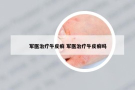 军医治疗牛皮癣 军医治疗牛皮癣吗