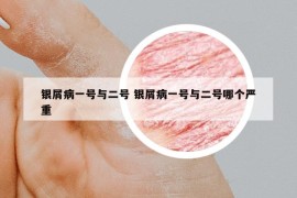 银屑病一号与二号 银屑病一号与二号哪个严重