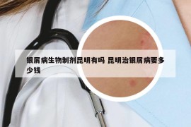 银屑病生物制剂昆明有吗 昆明治银屑病要多少钱