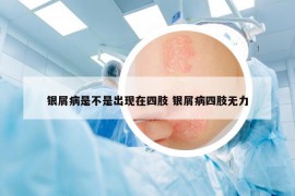 银屑病是不是出现在四肢 银屑病四肢无力