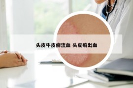 头皮牛皮癣流血 头皮癣出血