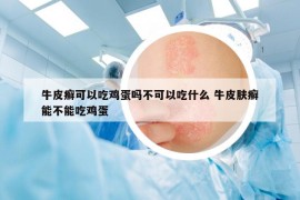 牛皮癣可以吃鸡蛋吗不可以吃什么 牛皮肤癣能不能吃鸡蛋