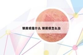 银屑症是什么 银屑症怎么治