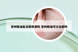 茶树精油能治银屑病吗 茶树精油可以治癣吗