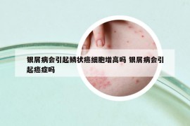 银屑病会引起鳞状癌细胞增高吗 银屑病会引起癌症吗