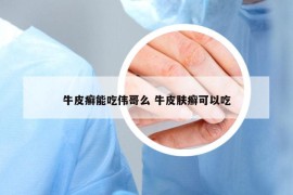 牛皮癣能吃伟哥么 牛皮肤癣可以吃